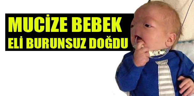 Mucize Bebek Eli Burunsuz Doğdu