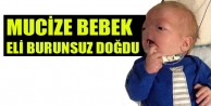 Mucize Bebek Eli Burunsuz Doğdu